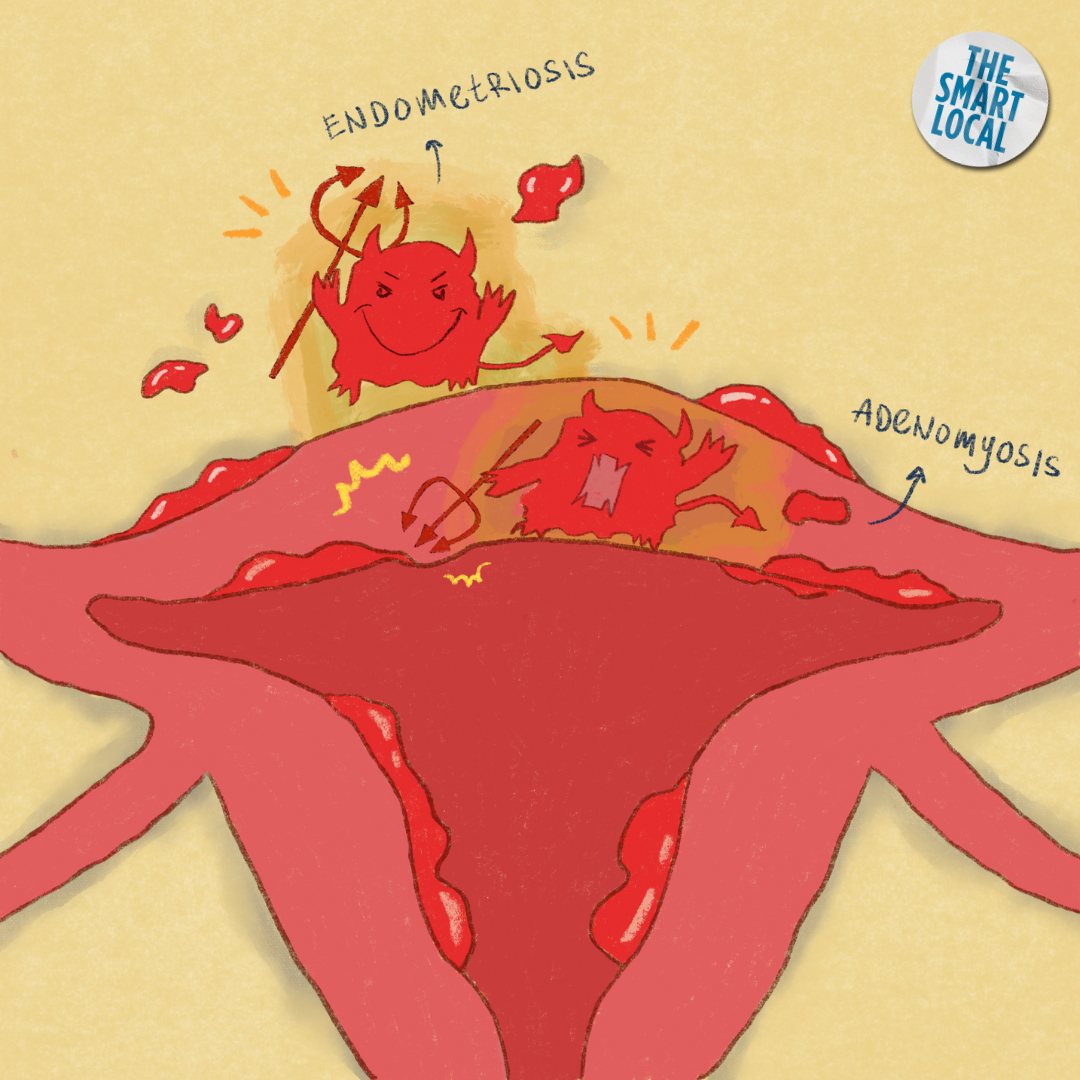 period cramps - adenomyosis